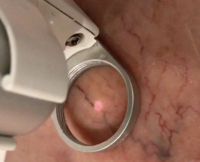 Laser removing spider veins