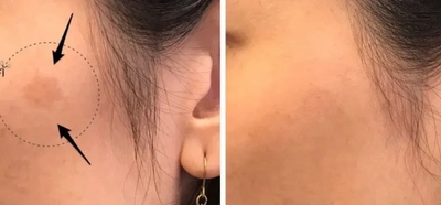 A before and after of a dark spot removed by laser dark spot removal