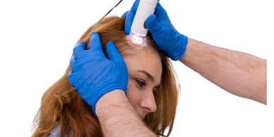 ALOPECIA DERMAPEN CENTRAL CARE