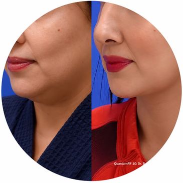 Before and after skin tightening on a woman's jawline and neck.