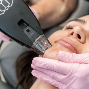 Facial skin treatment with a device on a woman's chin.