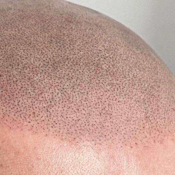Scalp Micro Pigmentation