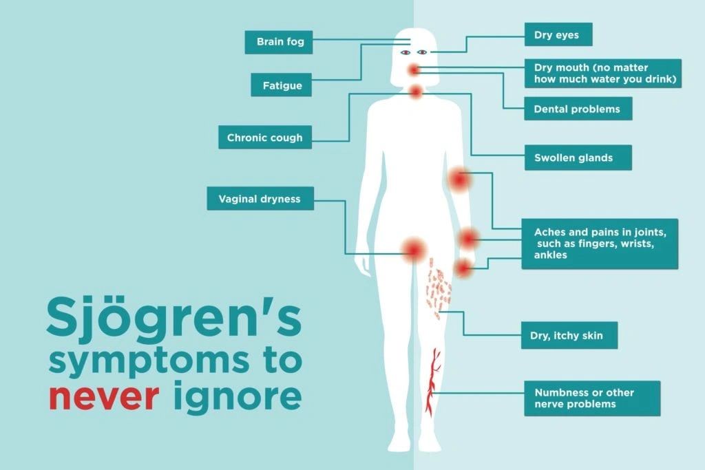 Sjogren's Syndrome Overview