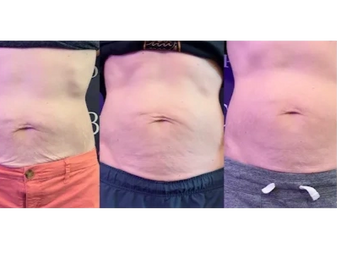 Skin toning & tightening services.