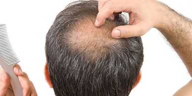 MALE PATTERN HAIR LOSS Cayman Islands