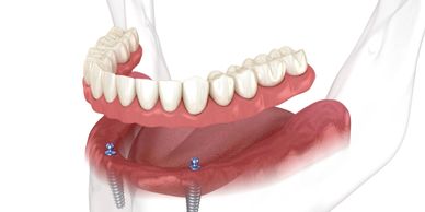 Implant-Supported Removable Dentures