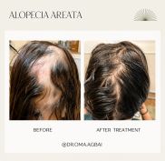 GLP-1 Medications and Hair Loss: Why It Happens and What to Do