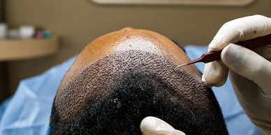 Close-up of a hair transplant procedure at the frontal hairline