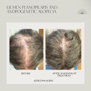 GLP-1 Medications and Hair Loss: Why It Happens and What to Do