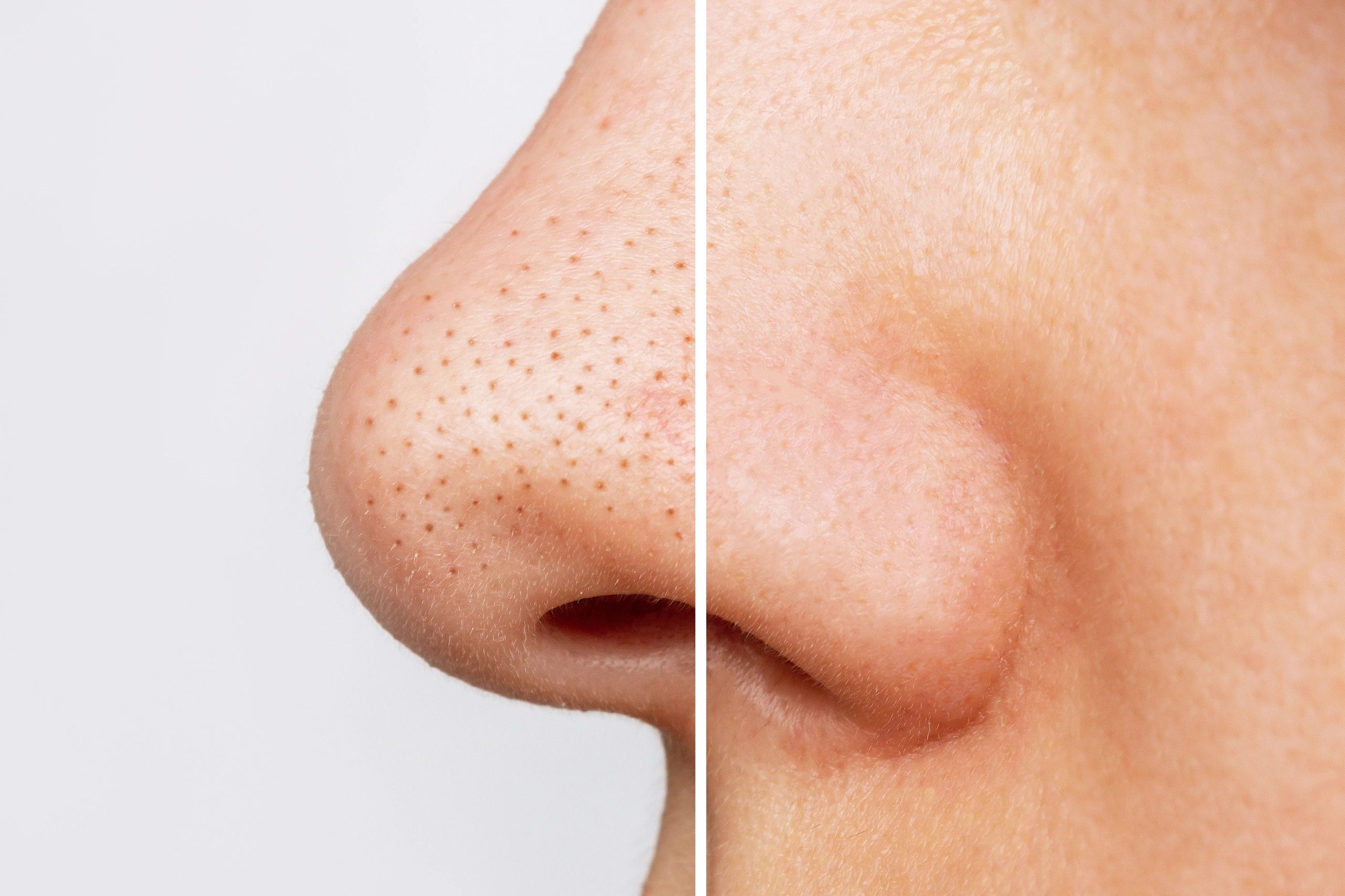 Blackhead Removal Blackhead Removal