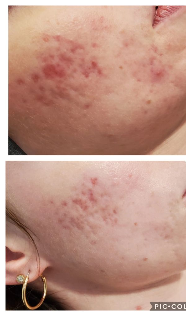 Microneedling & Nano-Needling Colchester