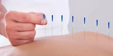 Dry needling
