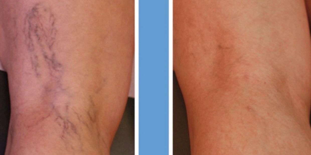 Spider vein treatment, sclerotherapy