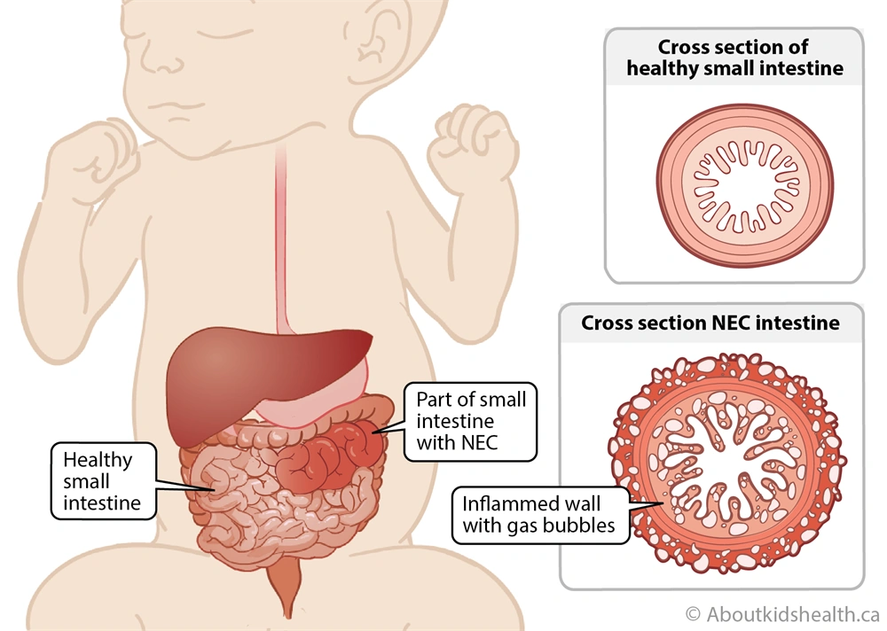 SimplyThick May Be Damaging Infants' Intestines : Shots - Health News : NPR