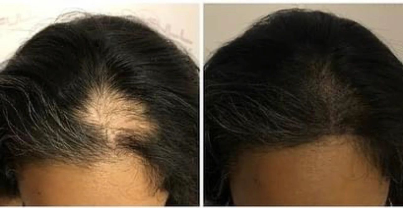 before and after photo of a women that has camouflaged her thinning hair using a hair tattoo