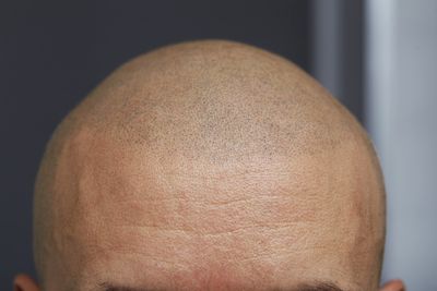 healed results of Scalp Micropigmentation/ Hair tattooing.