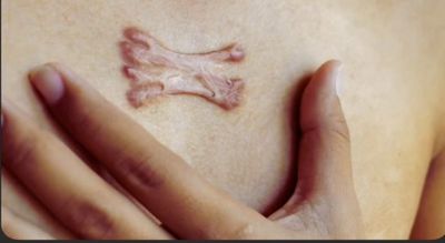 Are you bothered by raised thick scars that extend beyond the original injury site? You're not alone