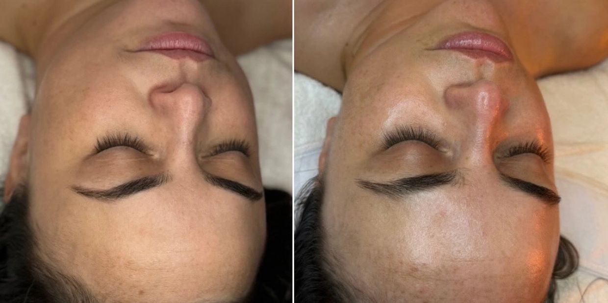 Chemical peel before and after with glymed plus peels. 