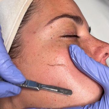 Dermaplaning to remove dead skin and peach fuzz to achieve radiant skin 