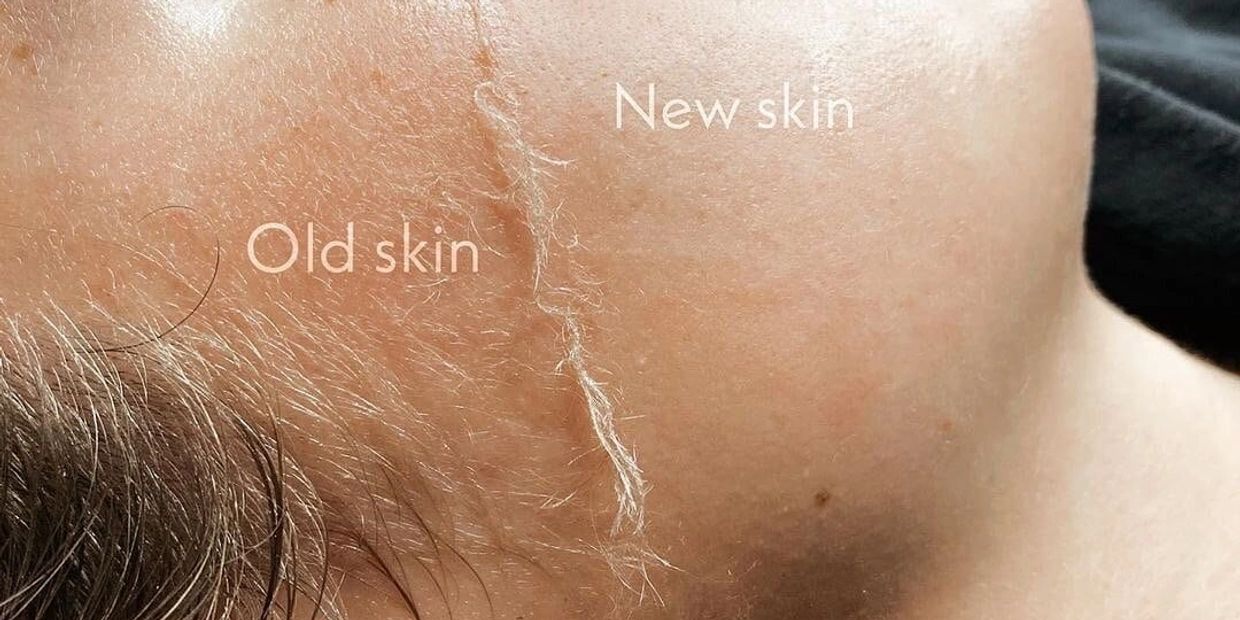 before and after of a dermaplane . the best dermaplane in the entire lake Norman area
