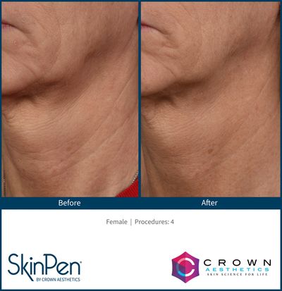 Microneedling with Skinpen
