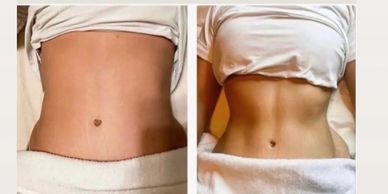 Delfin stomach vacuum from Colombia is a lymphatic drainage , tightens skin , aids at weight loss , 