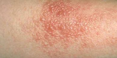 Picture of allergic contact dermatitis.