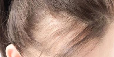 Picture of a woman with hair loss / thinning hair. 