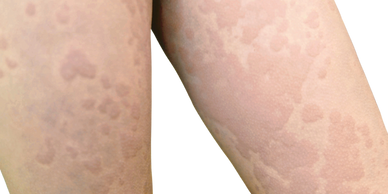 Picture of hives or urticaria.