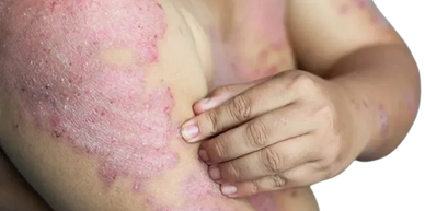 Picture of psoriasis.