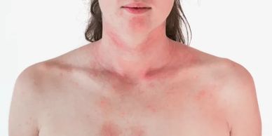 Picture of dermatitis, a skin condition.