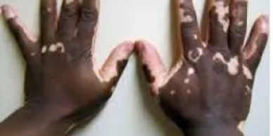 Image of hands with Vitiligo skin condition.