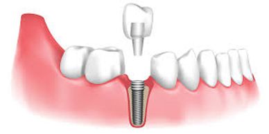 Illustration of a dental implant with crown placement.