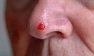 Close-up of a nose with a small fresh blood spot on the tip.