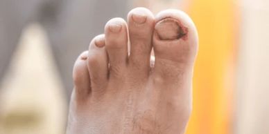 Close-up of a foot with an injured big toenail and bleeding.