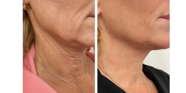 North Carolina Neck Lines Treatment