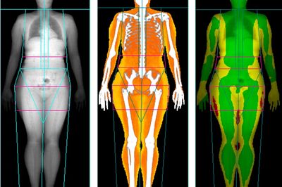 Dexa Body Composition Scan - Accurate Imaging Diagnostics DEXA at Accurate  Imaging Diagnostics