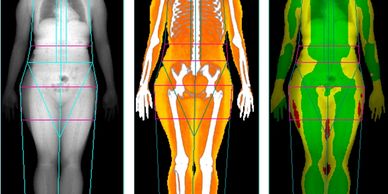 DEXA Scan - Aarthi Scans and Labs