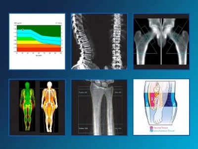 Bone Density Scan (DEXA)  Rowe Creavin Medical Practice
