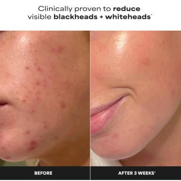 SKIN 2 BHA Liquid  