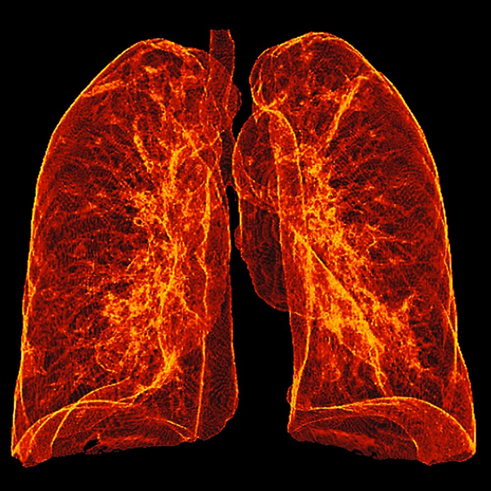 Radon causes lung cancer