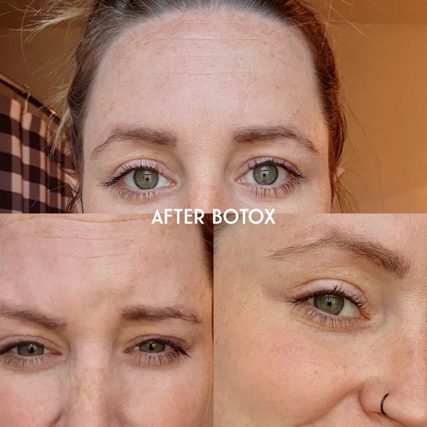 After Botox Lacy