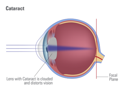 Diagram of an eye with light focusing on the retina.