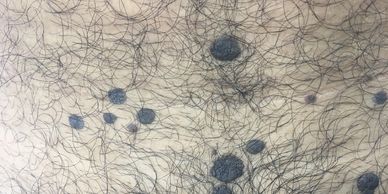 Laser for Warts • Dr Kuldeep Bhardwaj, Contact Dermatologist in Jabalpur for Skin, Hair & treatments