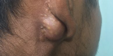 Nodulo Cystic Acne Treatments • Dr Kuldeep Bhardwaj, Dermatologist in Jabalpur