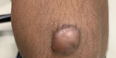 Dr Kuldeep Bhardwaj • Laser Keloid Removal • Contact 9753312312