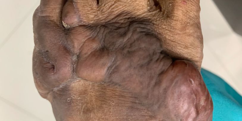Hypertrophic scar Treatments • Dr Kuldeep Bhardwaj, Dermatologist in Jabalpur