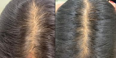 Female Pattern Hair Loss • Hair Treatments • Dr Kuldeep Bhardwaj, Dermatologist in Jabalpur 