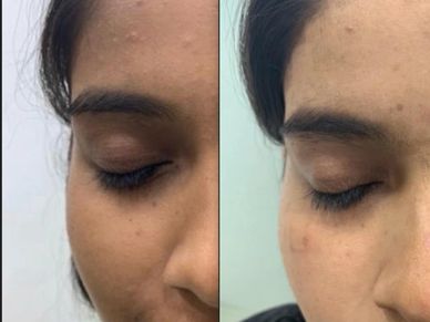 Laser for Skin Whitening | Dr Kuldeep Bhardwaj, Dermatologist in Jabalpur