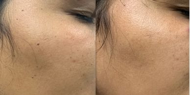 Dr Kuldeep Bhardwaj • Laser Skin tag Removal